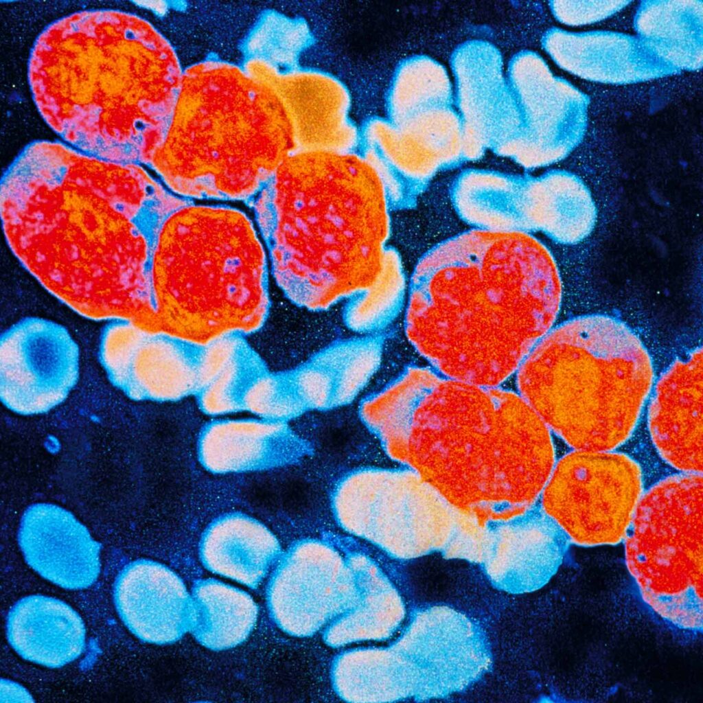 Acute Myeloid Leukemia Aml Greenjay Therapeutics Acute Myeloid Leukemia Aml Greenjay Therapeutics